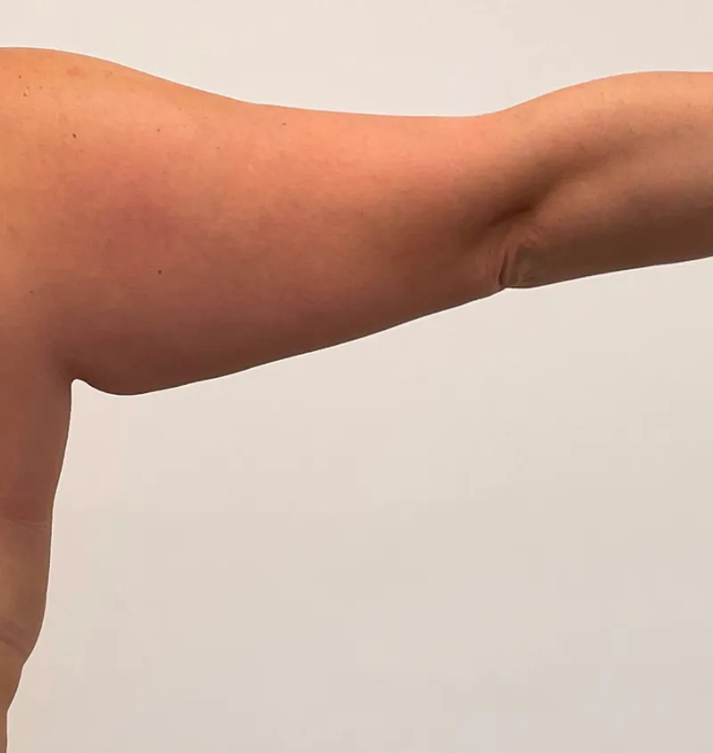 Arm lift before and after back image