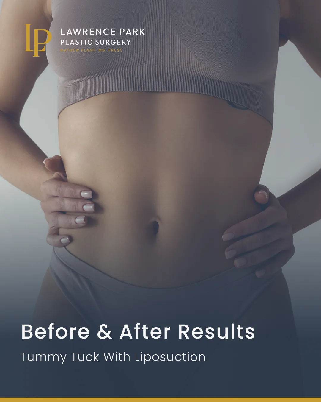Before and after tummy tuck with liposuction