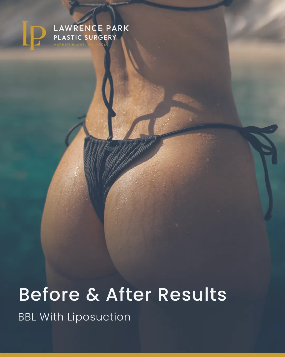 Before and after brazilian butt lift