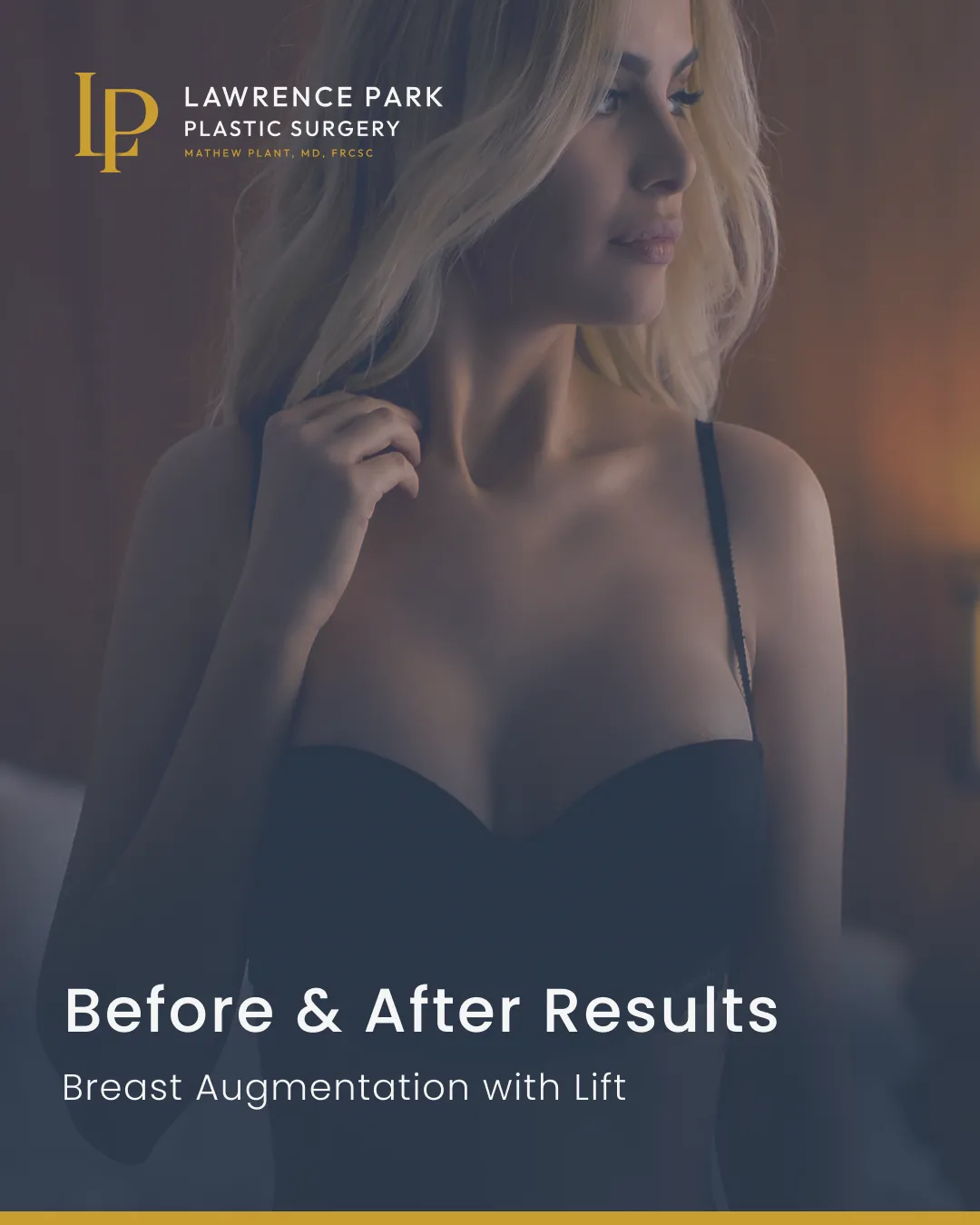 Before and after breast augmentation with lift