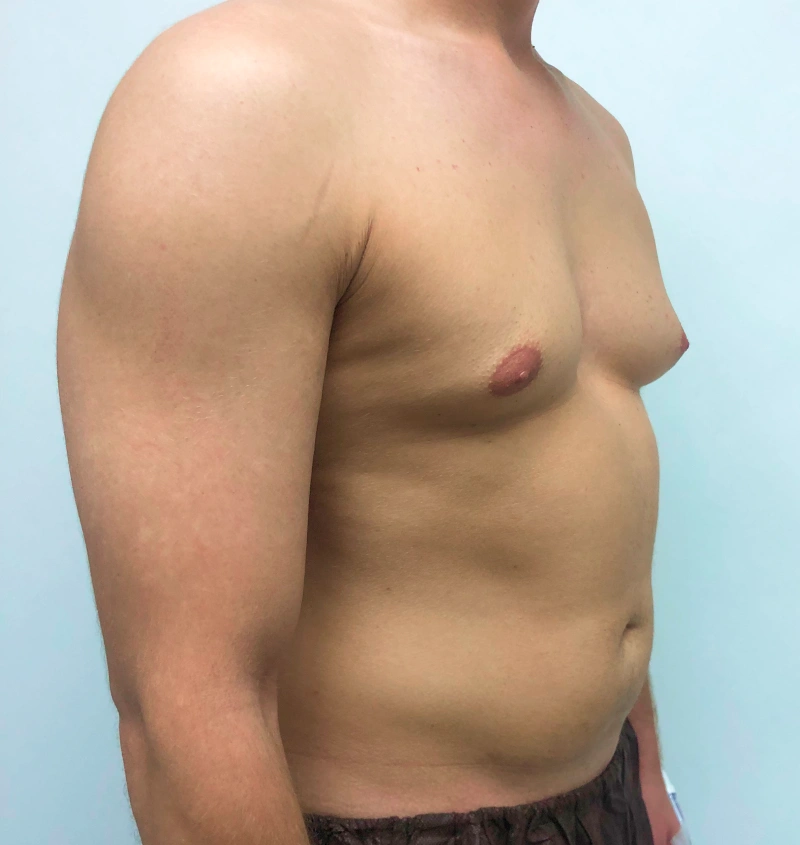 Male breast reduction before and after results, side view
