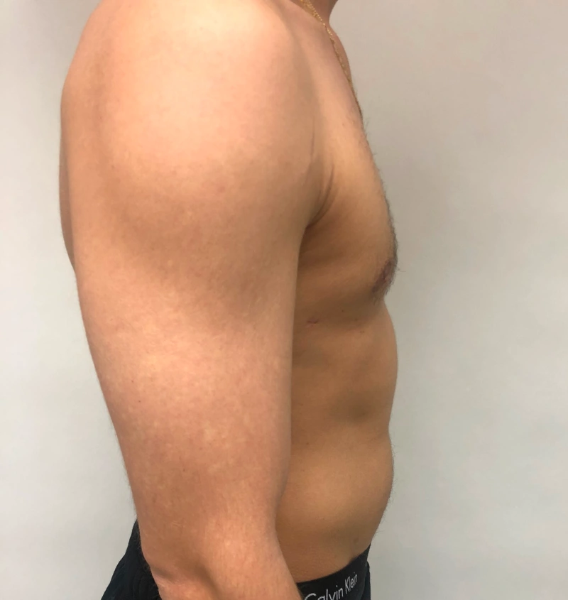 Male breast reduction before and after results, side view