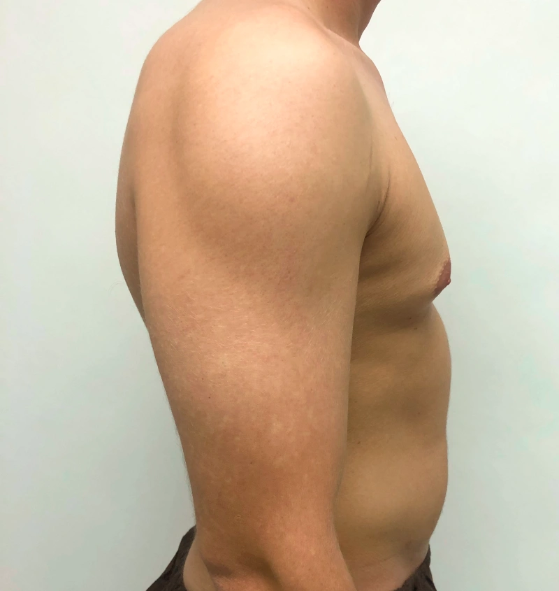 Male breast reduction before and after results, side view