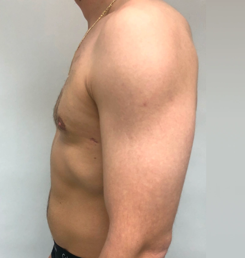 Male breast reduction before and after results, side view