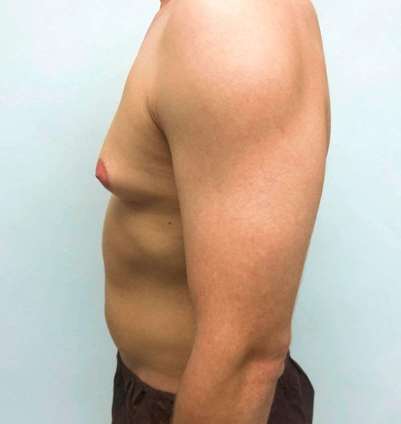 Male breast reduction before and after results, side view