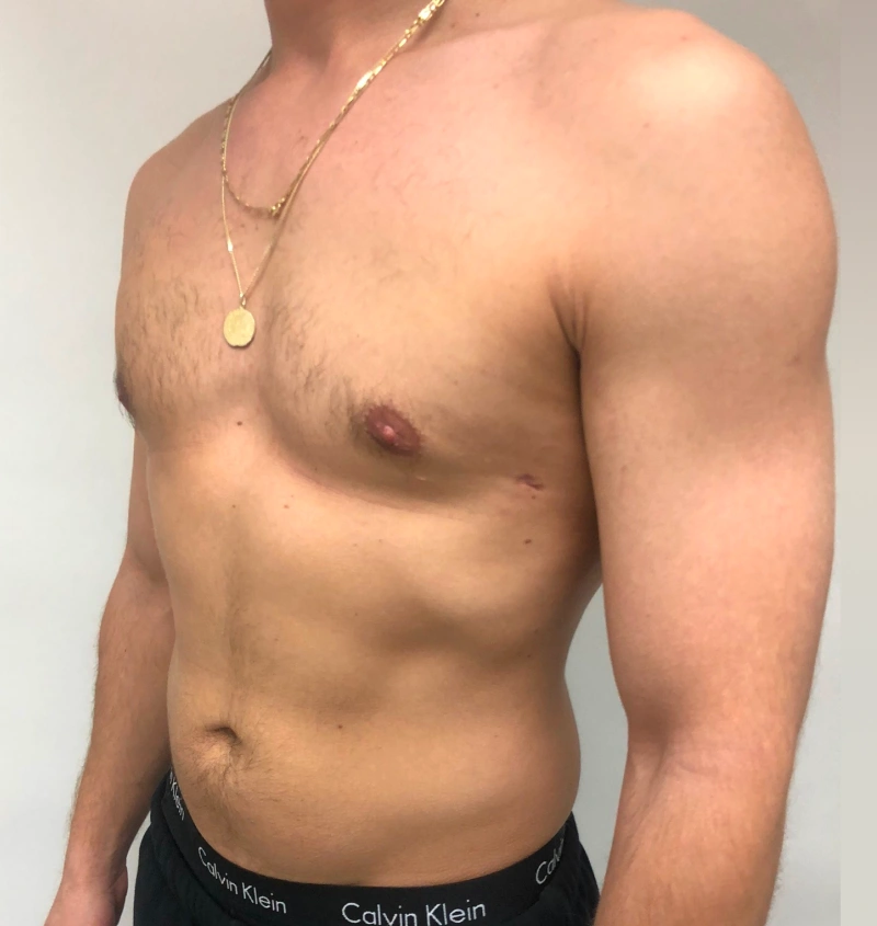 Male breast reduction before and after results, side view