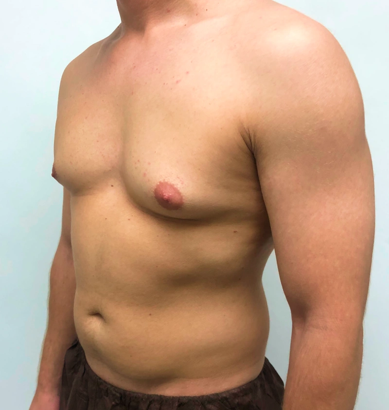 Male breast reduction before and after results, side view