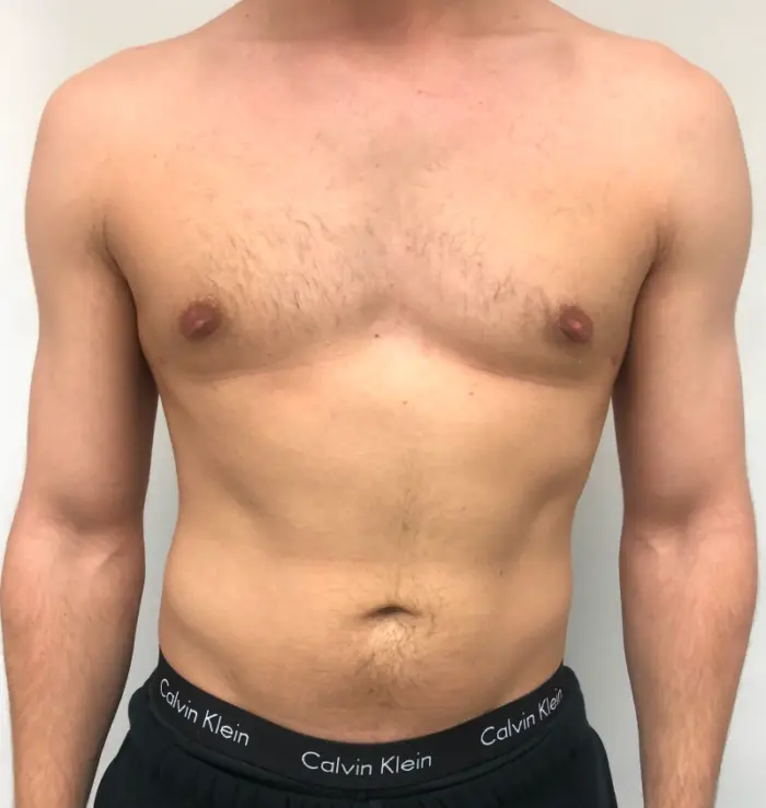 Male breast reduction before and after results, front view