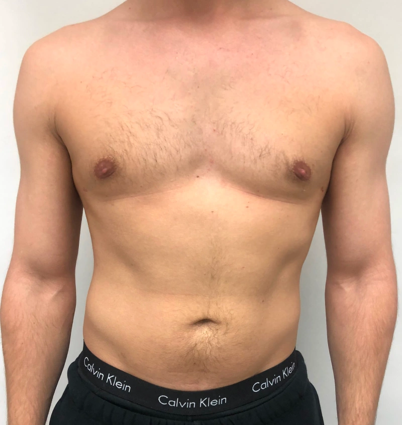 Male breast reduction before and after results, front view