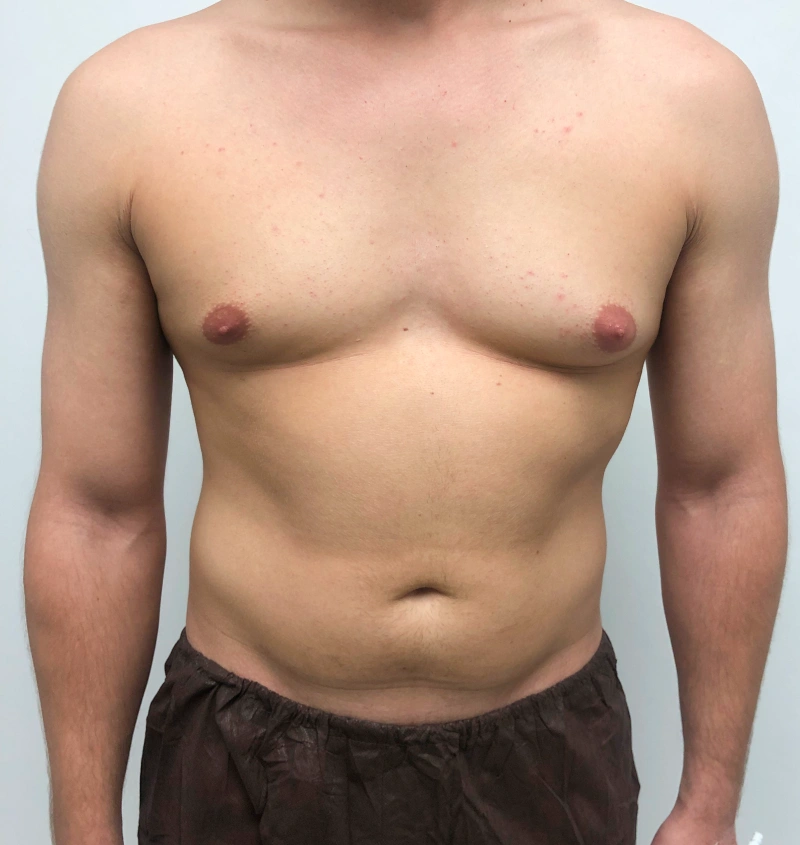 Male breast reduction before and after results, front view
