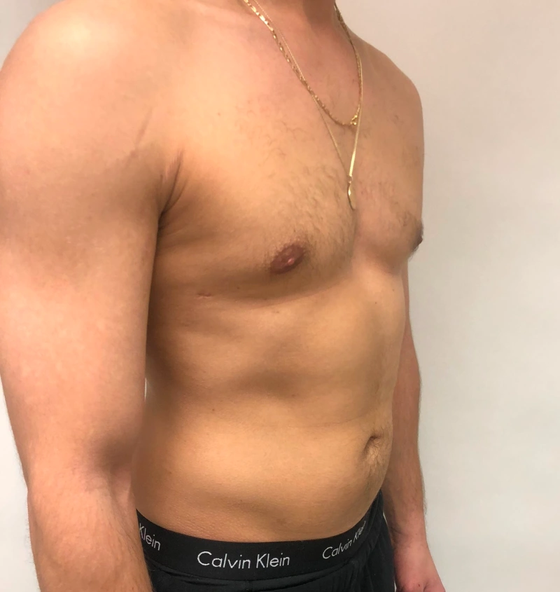 Male breast reduction before and after results, side view