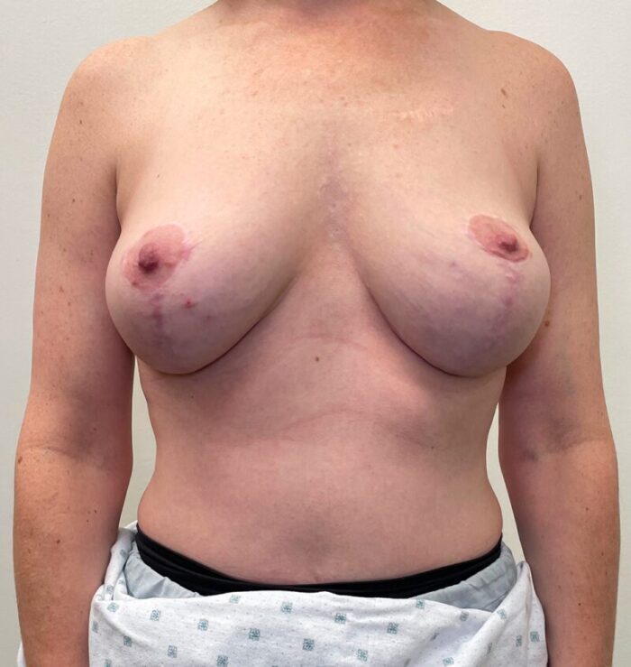 Post weight loss surgery results front view