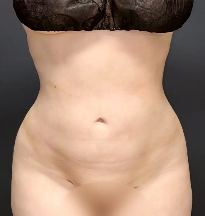 Liposuction results before and after for toronto surgery, front view