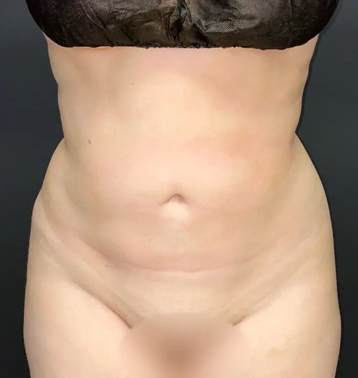 Liposuction results before and after for toronto surgery, front view
