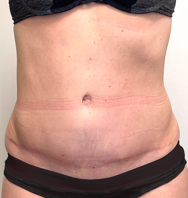 Tummy tuck after pregnancy before after front view