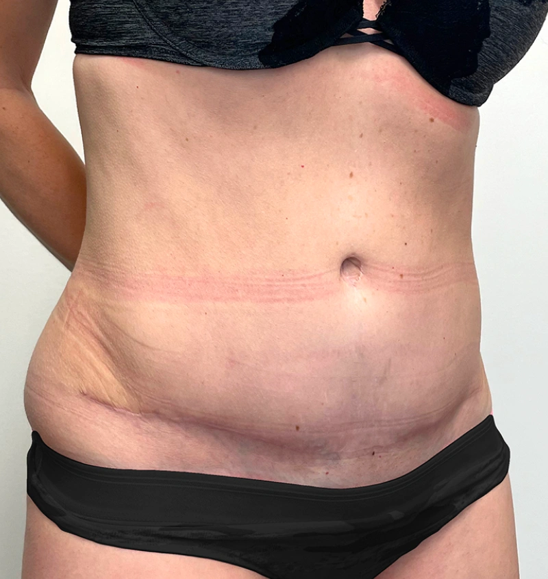 Tummy tuck after pregnancy before after side view