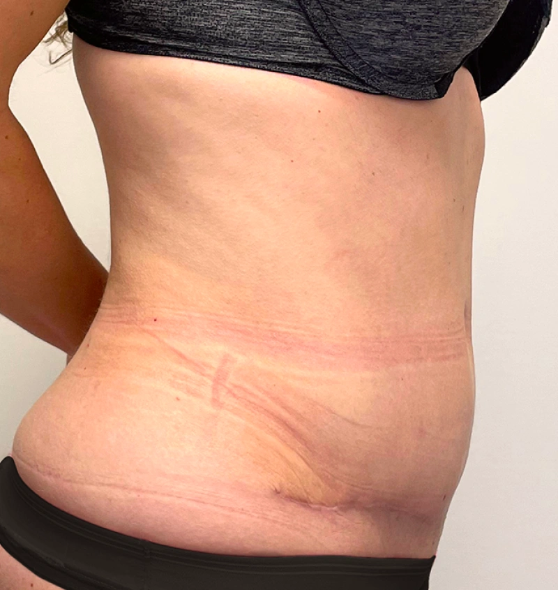 Tummy tuck after pregnancy before after side view