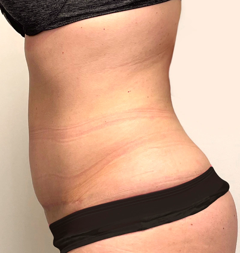 Tummy tuck after pregnancy before after side view