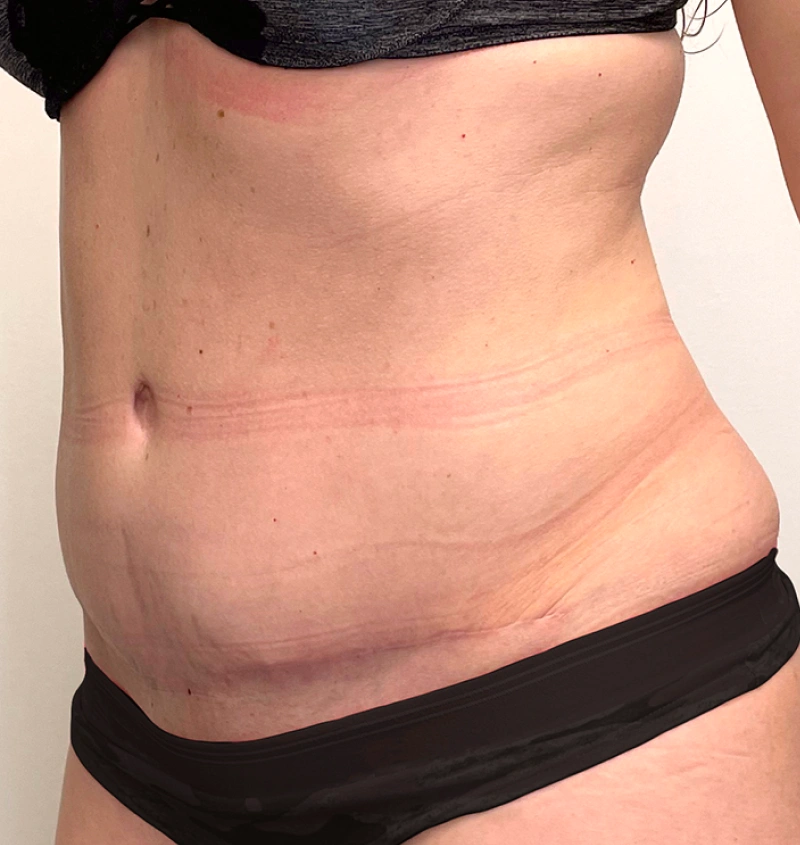 Tummy tuck after pregnancy before after side view