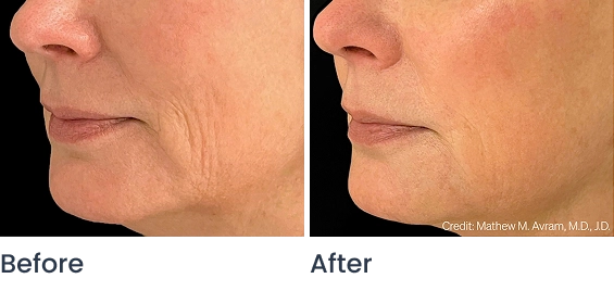 ellacor before and after results