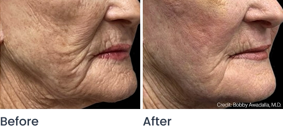 ellacor before and after results senior