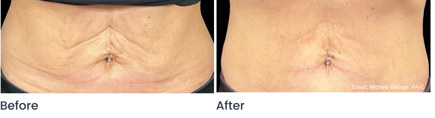 ellacor before and after results