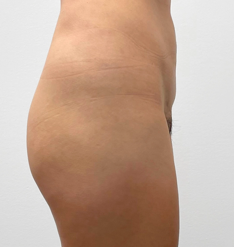 BBL and liposuction before and after side view