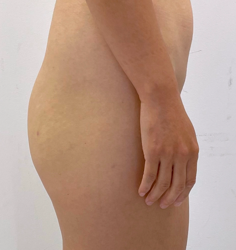 BBL and liposuction before and after side view