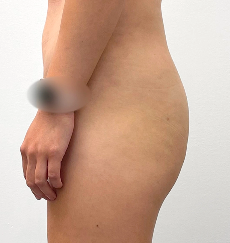 BBL and liposuction before and after side view
