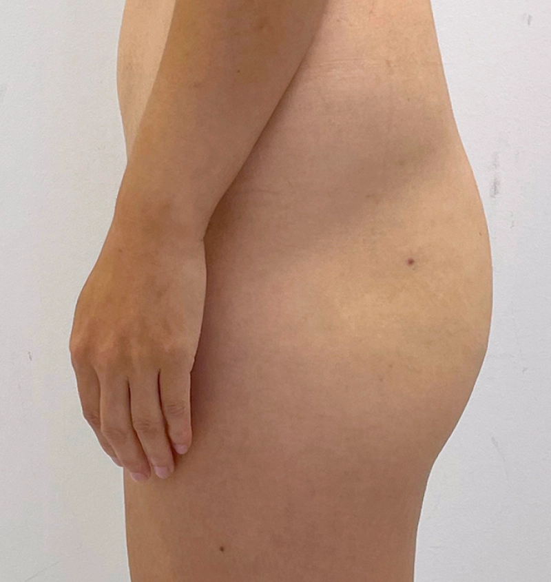 BBL and liposuction before and after side view