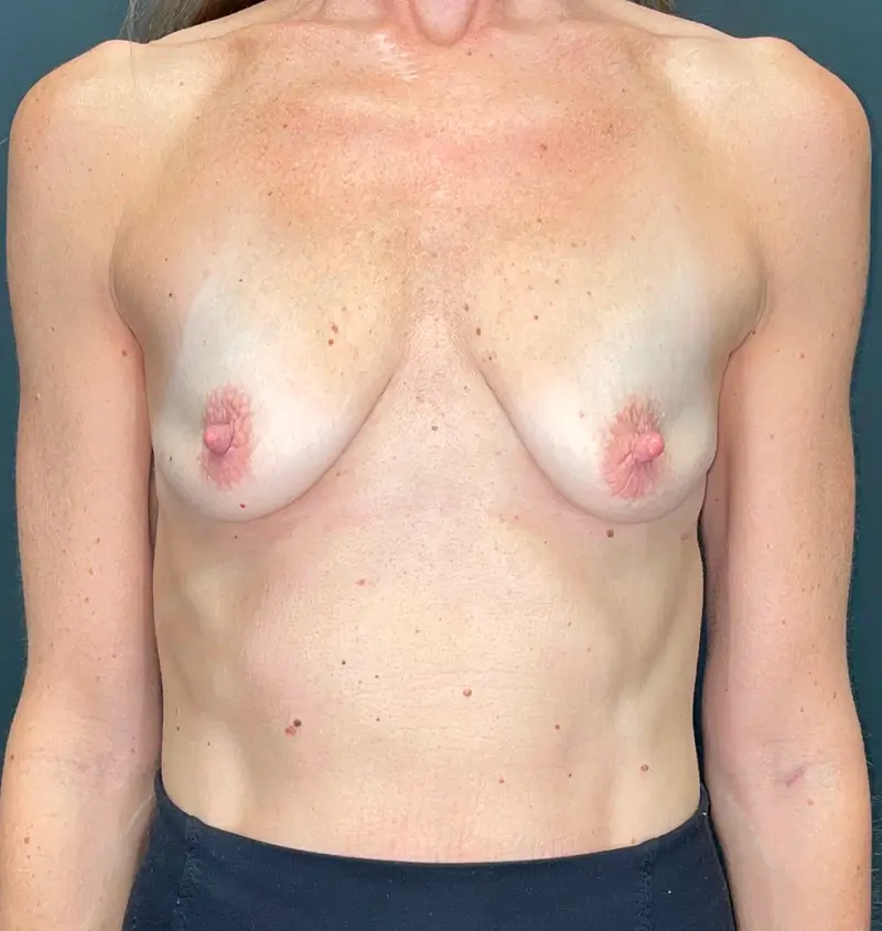 Breast augmentation and lollipop lift results front view