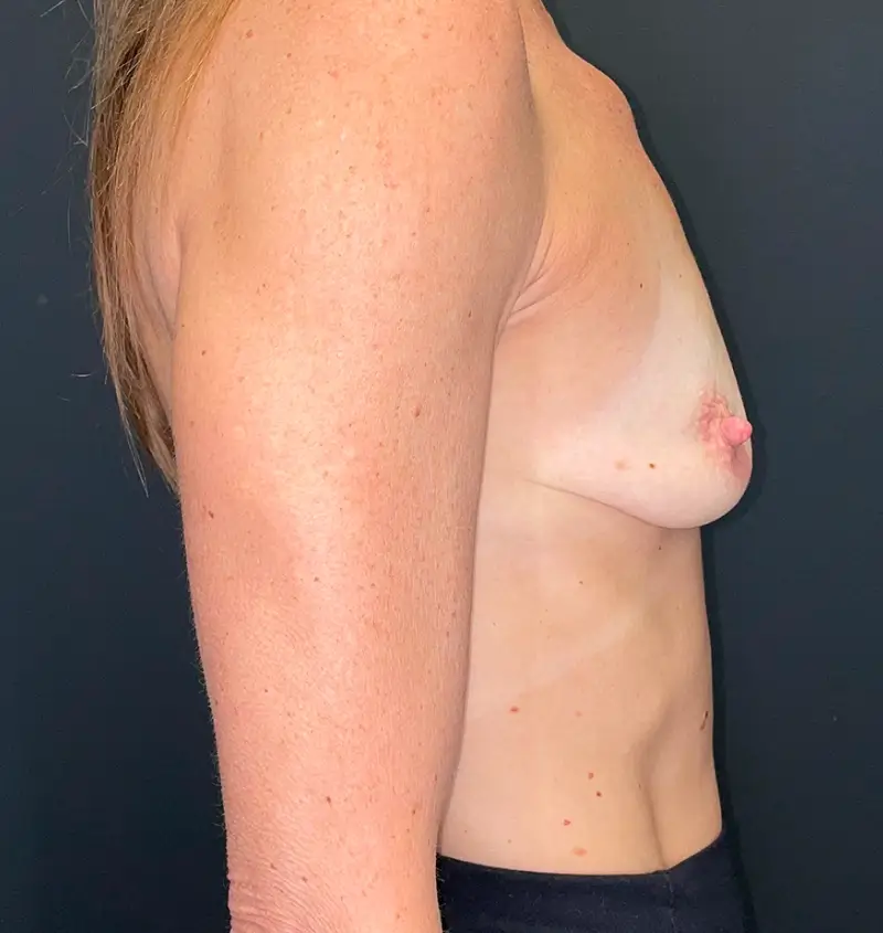 Breast augmentation and lollipop lift results side view