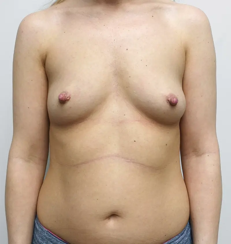Breast augmentation post pregnancy results front view