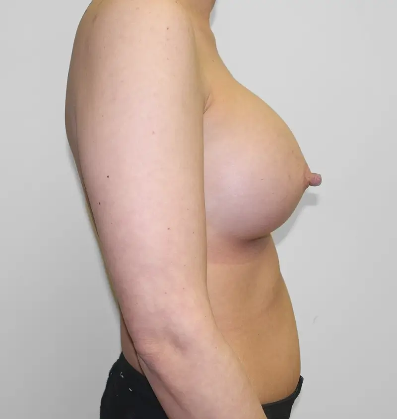 Breast augmentation post pregnancy results side view