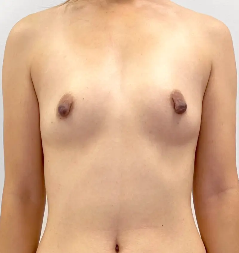 High-profile breast implant results front view