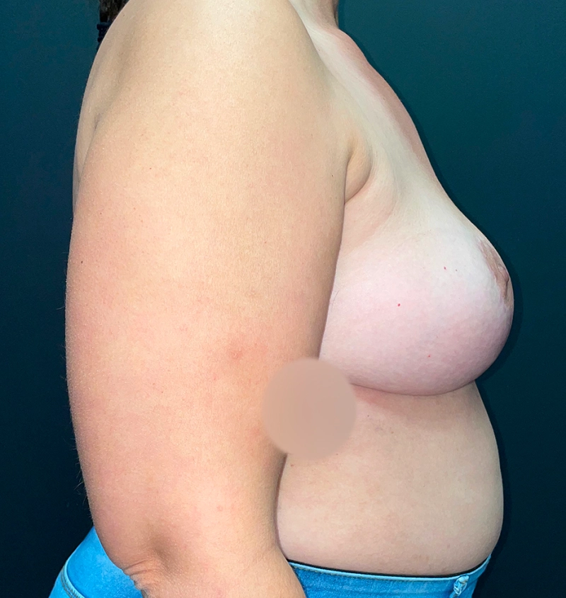 Explant before and after results side view
