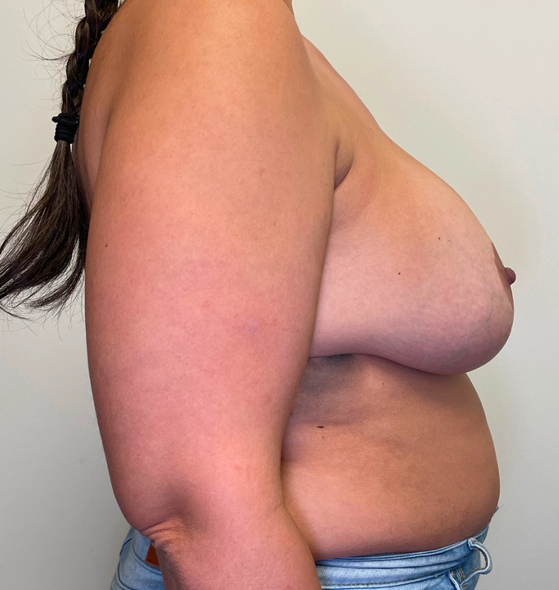 Explant before and after results side view