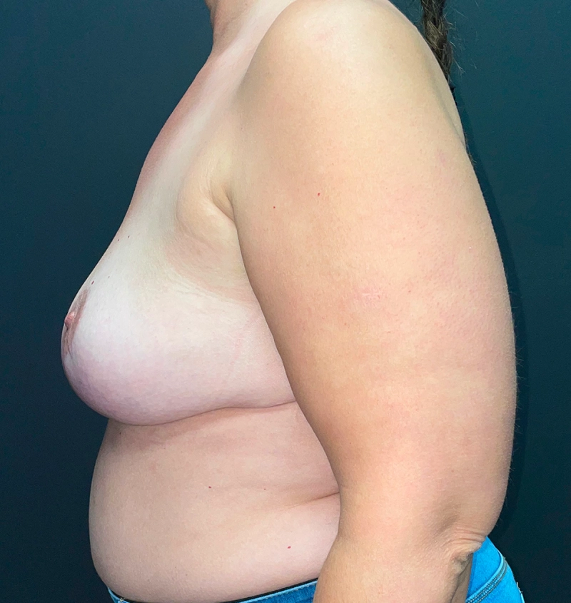 Explant before and after results side view