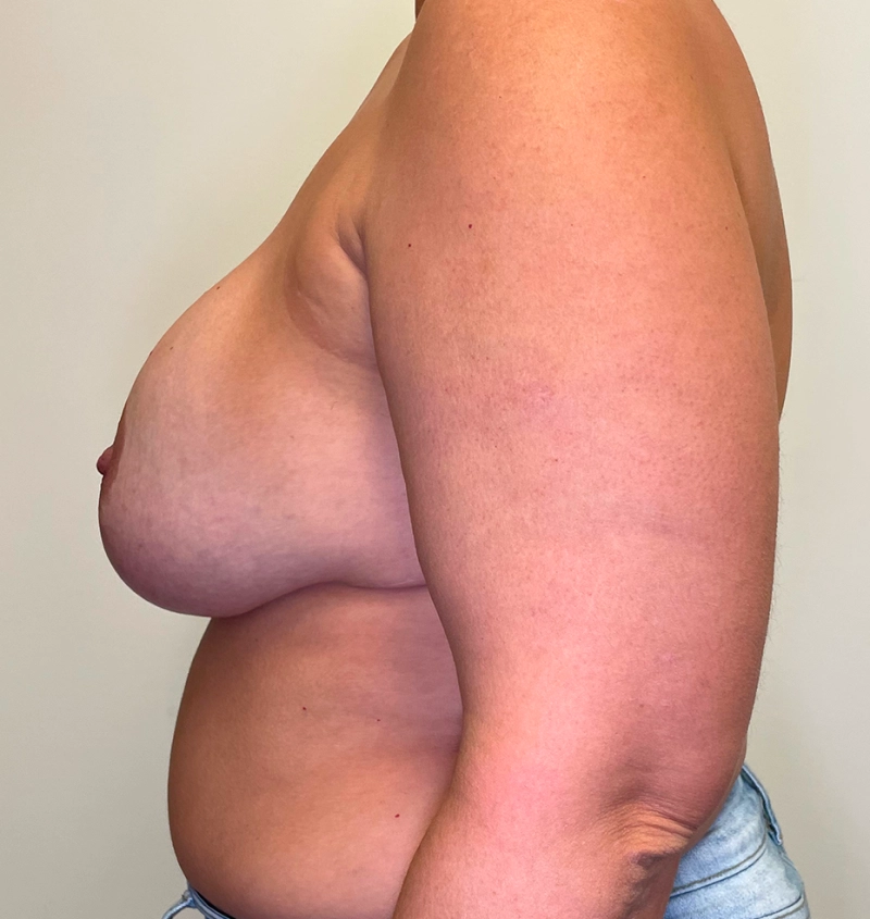 Explant before and after results side view