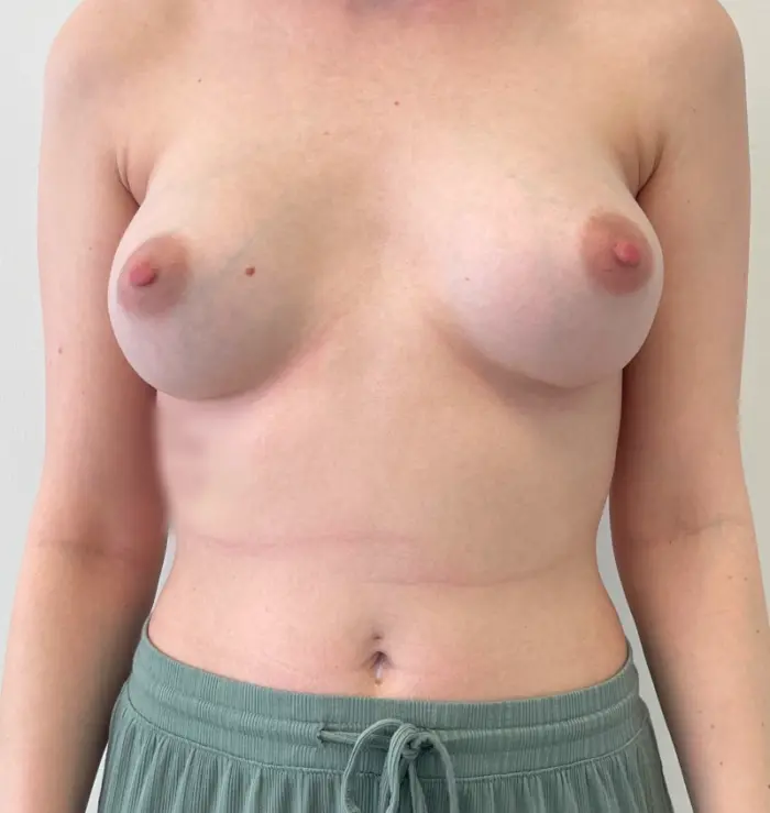 Capsular Contracture Before & After Results Front View