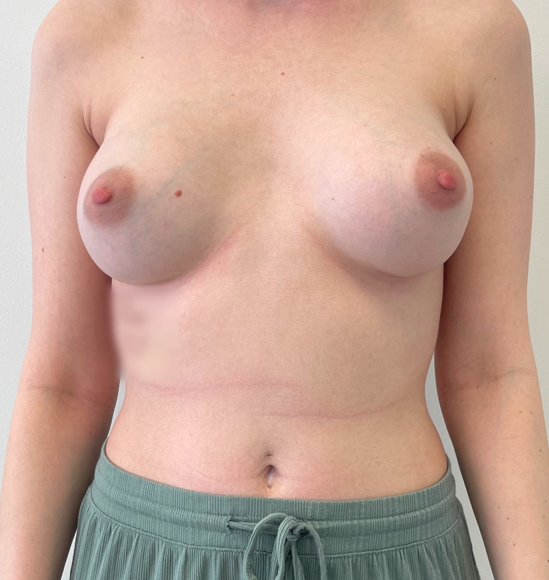 Capsular Contracture Before & After Results Front View