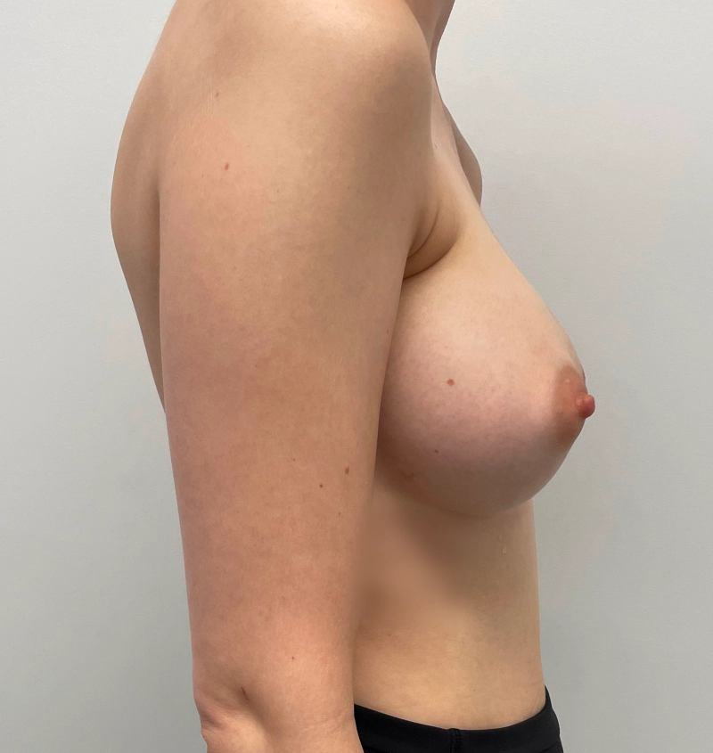 Capsular Contracture Before & After Results Side View