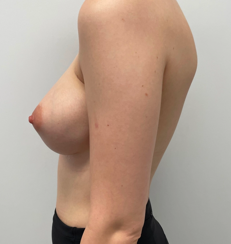 Capsular Contracture Before & After Results Side View
