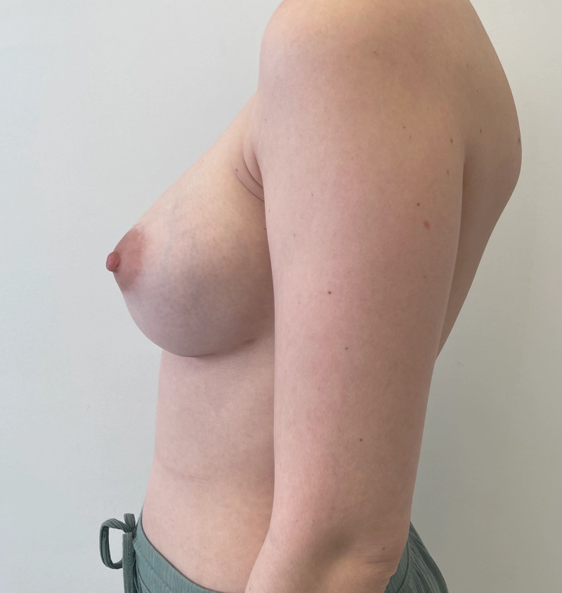 Capsular Contracture Before & After Results Side View