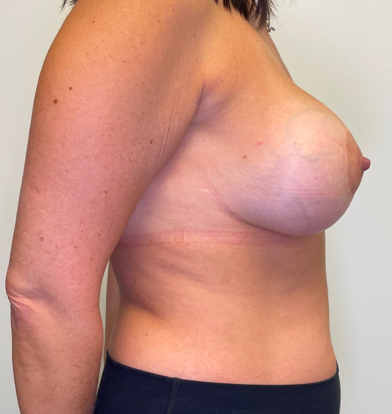 Capsular Contracture Surgery Before & After Side View