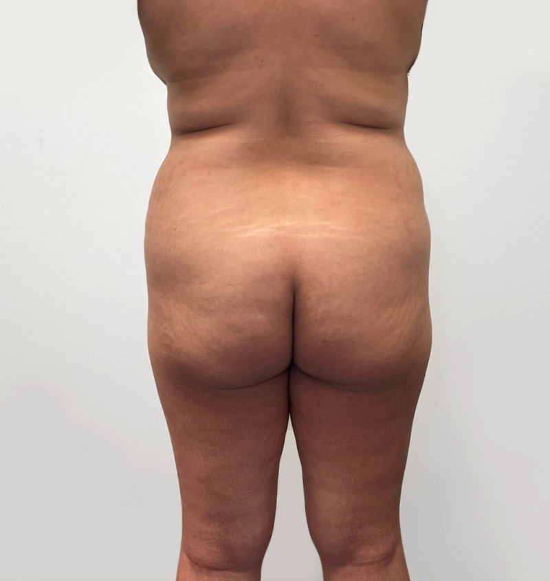 BBL before and after from mommy makeover