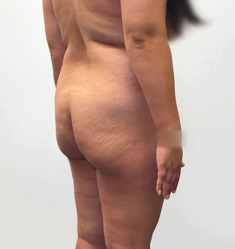 BBL before and after from mommy makeover