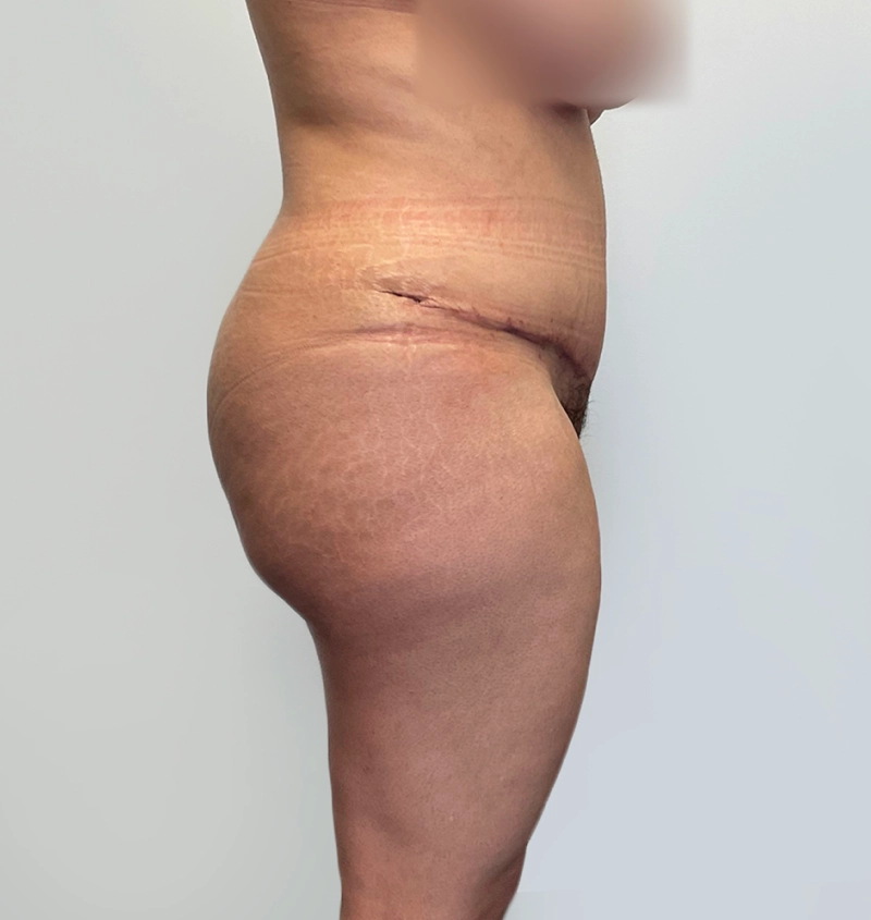 BBL before and after from mommy makeover