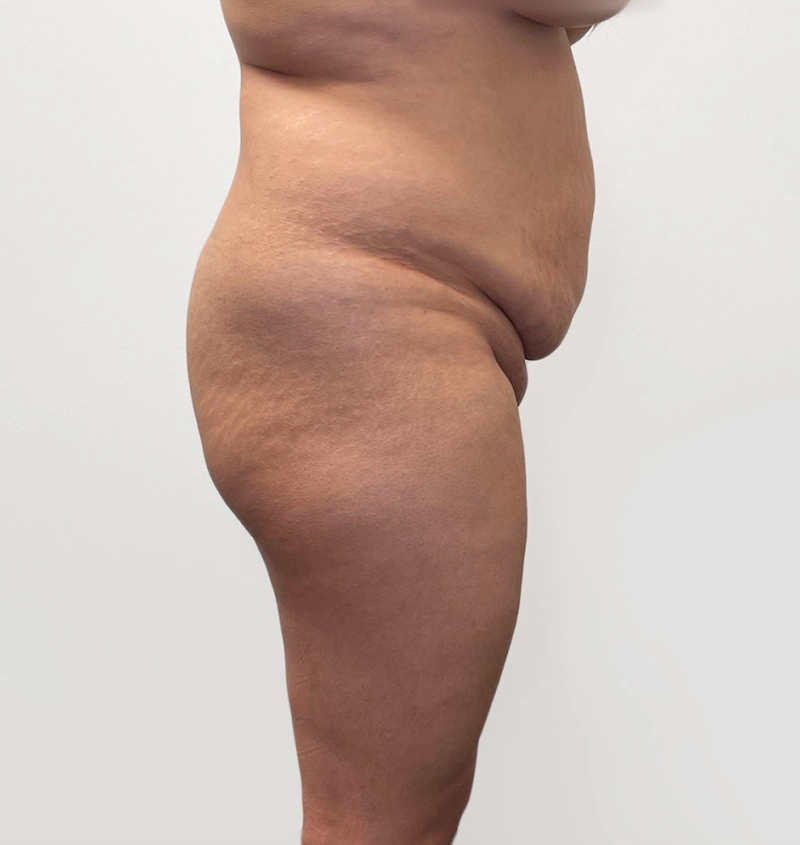 BBL before and after from mommy makeover
