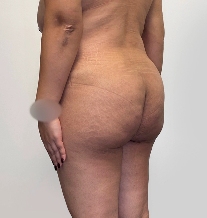 BBL before and after from mommy makeover